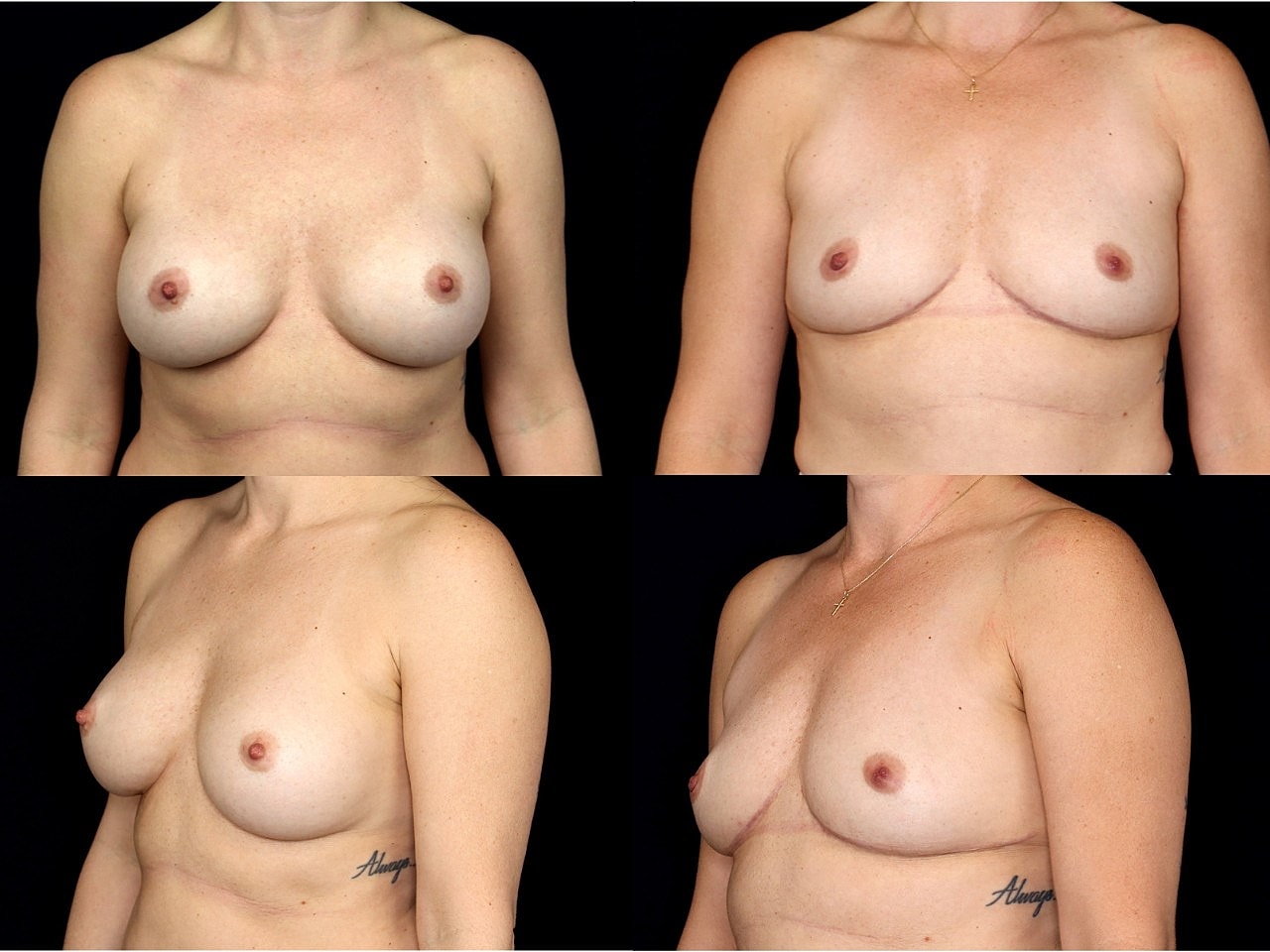 Breast Explant 1