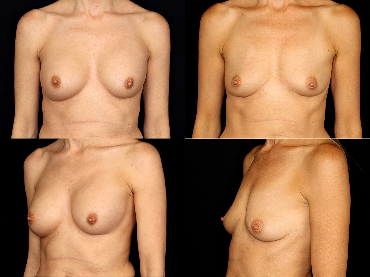 Breast Explant 8